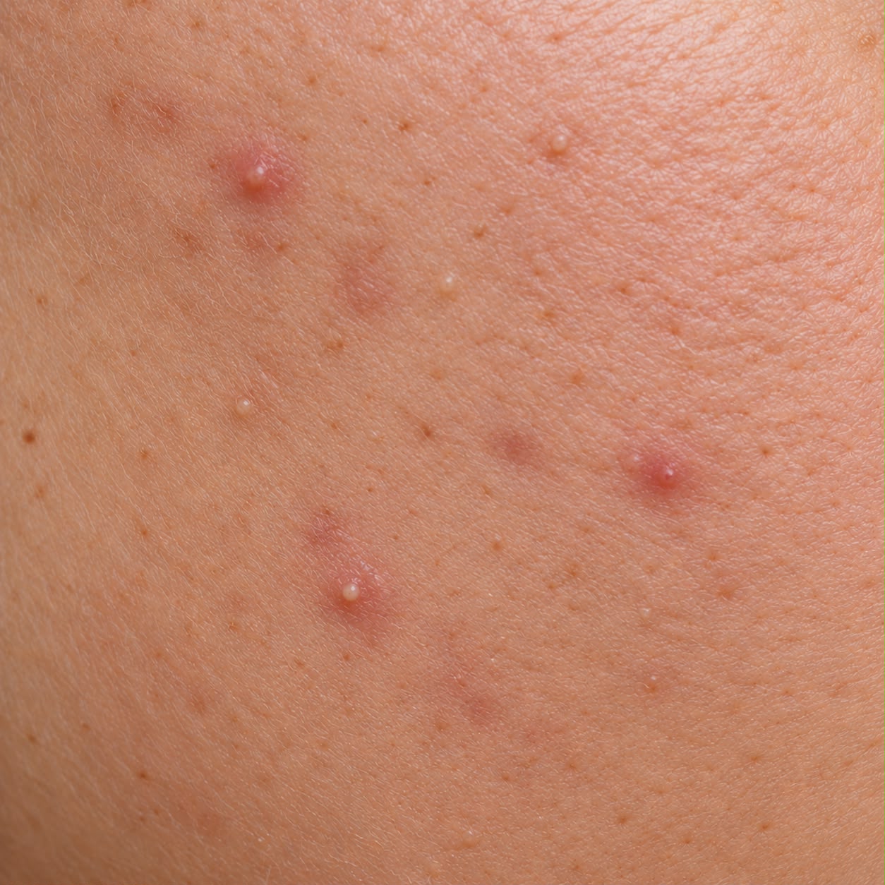 Acne/Oily skin
