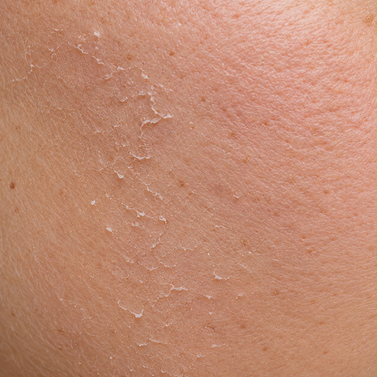 Dry skin