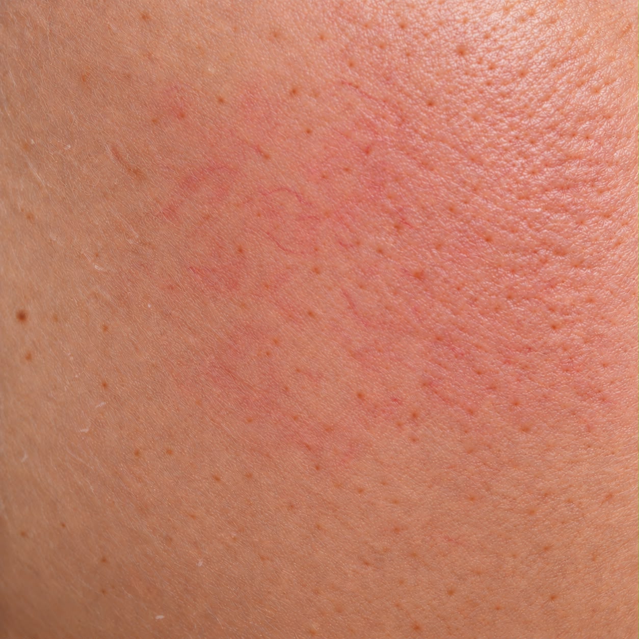 Sensitive skin